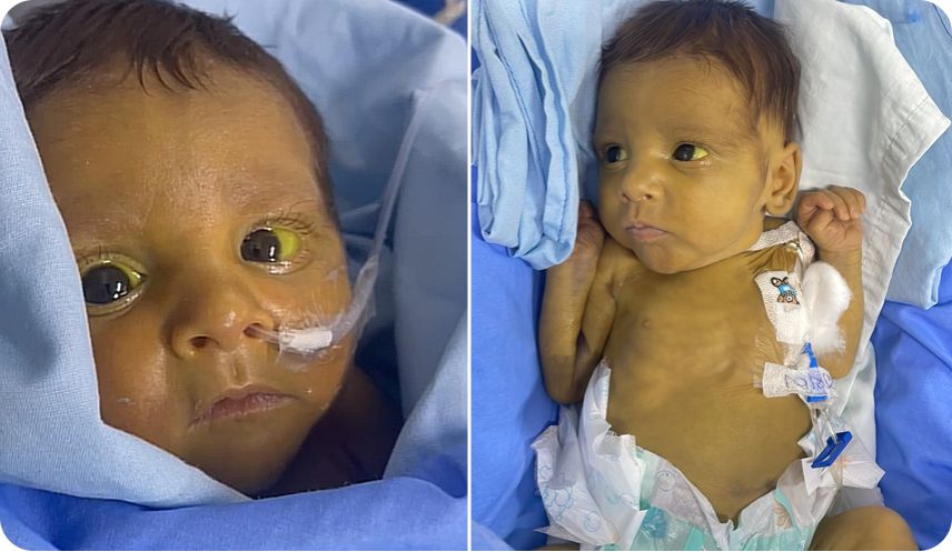 Bebê recém-nascido fica com olhos e pele amarelados após trombose no fígado. Desesperada, mãe pede ajuda para tratamento do filho