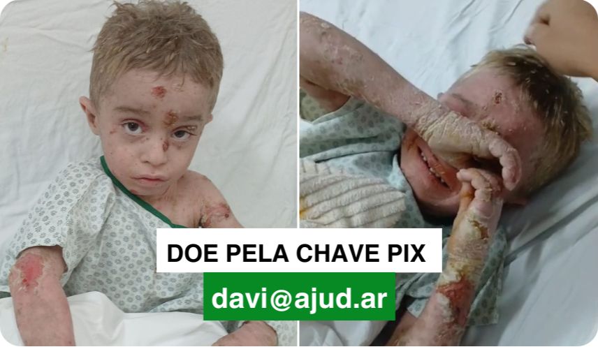 Com doença rara que causa bolhas que sangram, criança de 6 anos chora de dor e por viver internado