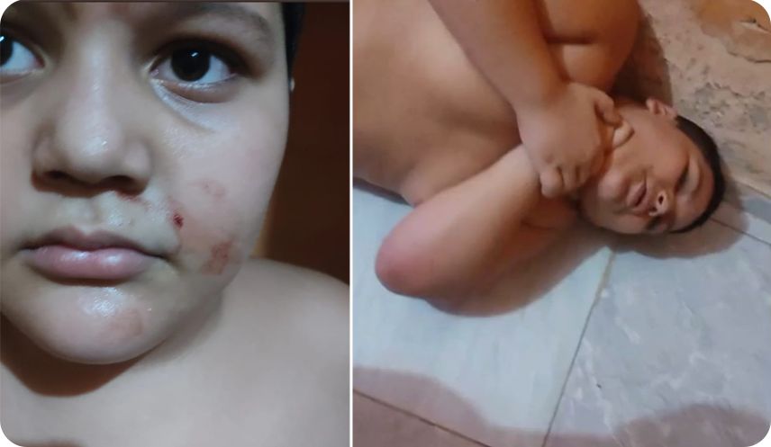 Vaquinha para tratamento de menino autista que durante surtos fura o nariz até sangrar, se enforca e bate a cabeça na parede