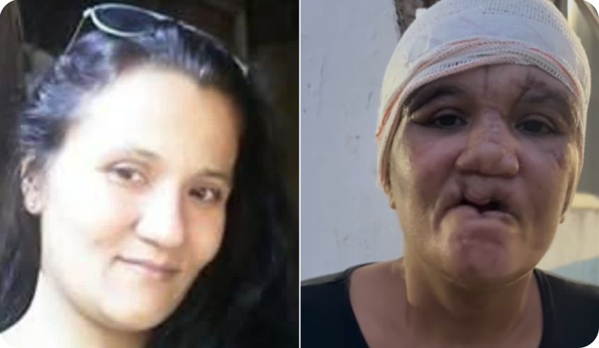 Marcia que foi vítima de feminicídio teve o couro cabeludo e os dentes arrancados pelo marido. Ela sonha em recuperar o sorriso e recomeçar.