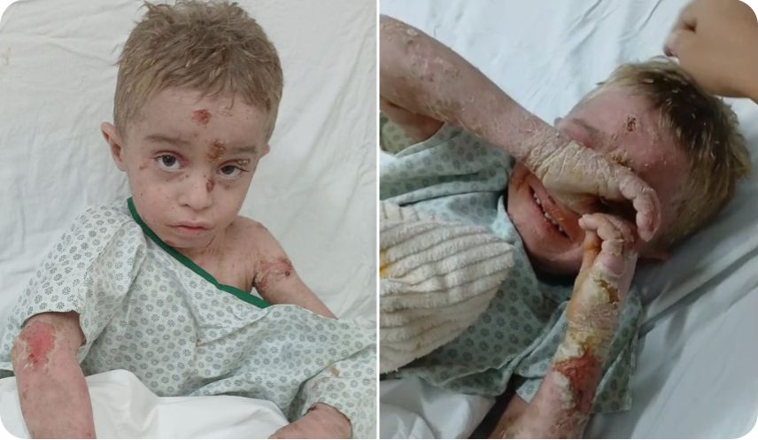 Com doença rara que causa bolhas que sangram, criança de 6 anos chora de dor e por viver internado