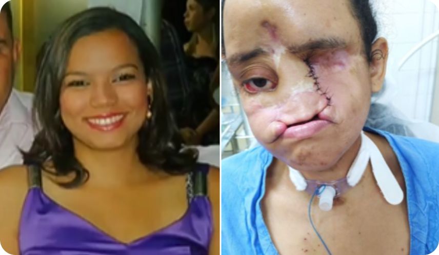 Vaquinha para tratamento da Talita, que perdeu nariz, lábio e olho para câncer agressivo no rosto