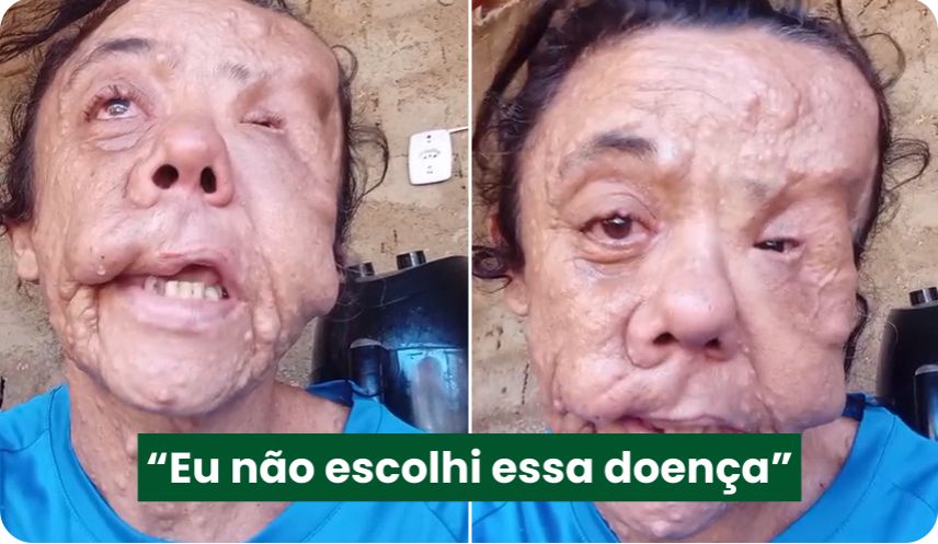 Humilhada por sua aparência, Marta, que tem doença rara, cata latinhas para sobreviver