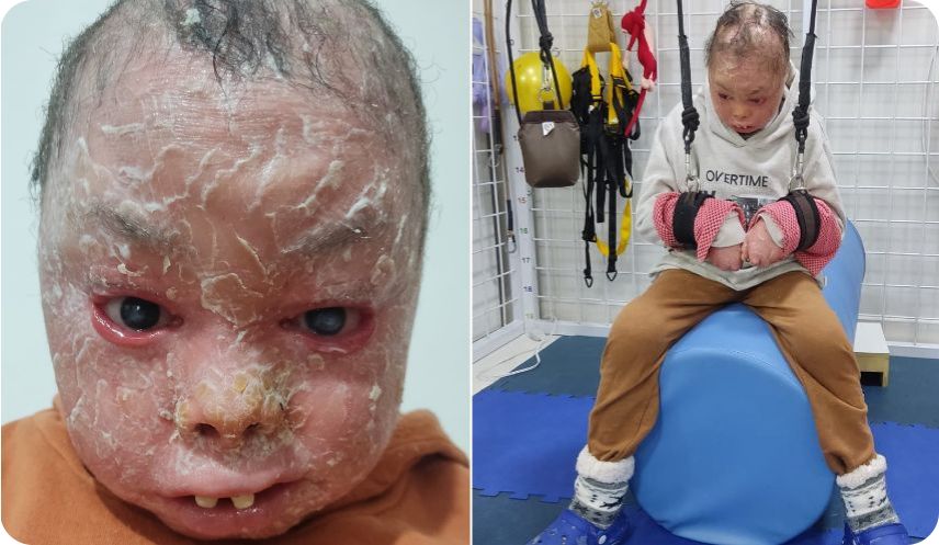 Ajude o Nicolas, que tem doença rara e sem cura. Ele sente muita dor, não anda nem fecha os olhos, e precisa de cirurgia de fimose