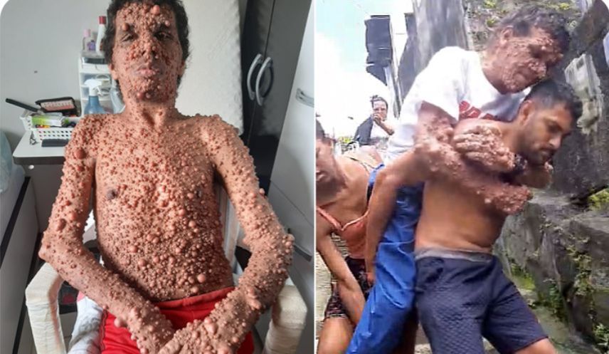 Banner Vaquinha para Felipe, que tem tumores no corpo todo, paralisia e é cuidado pela mãe idosa sozinha