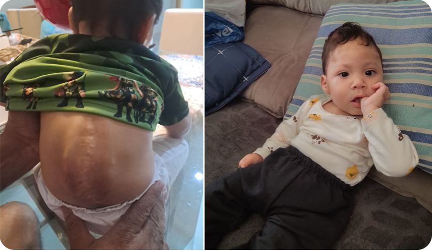 Banner “O SUS espera a criança deformar”, diz mãe de bebê de 1 ano que precisa de cirurgia na coluna urgente