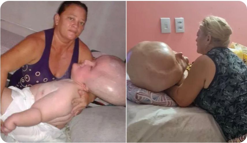 Mãe cuida sozinha da filha de 32 anos com hidrocefalia gigante abandonada pelo genitor. Ela carrega a filha no colo igual uma bebê. 