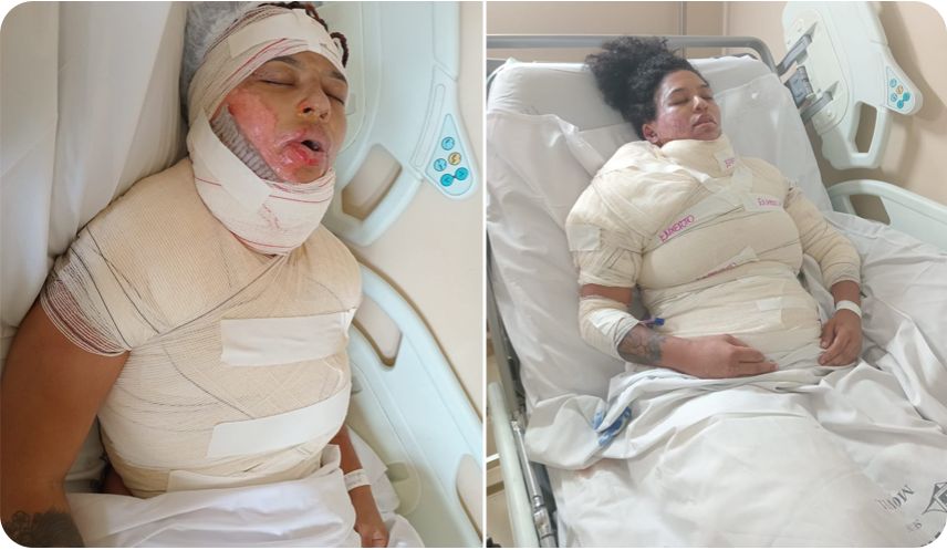 Desumano: mulher com queimaduras graves recebe ordem de despejo enquanto lutava pela vida no hospital