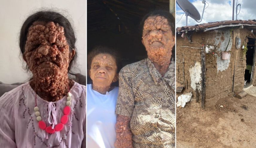 Mãe e filha idosas lutam contra tumores por todo o corpo; uma vive em casa de taipa sem banheiro e precisa fazer suas necessidades no mato