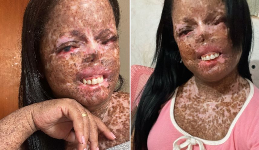 Ajude no tratamento da Juliana. Ela tem um câncer que provoca feridas que chegam aos ossos e sangram