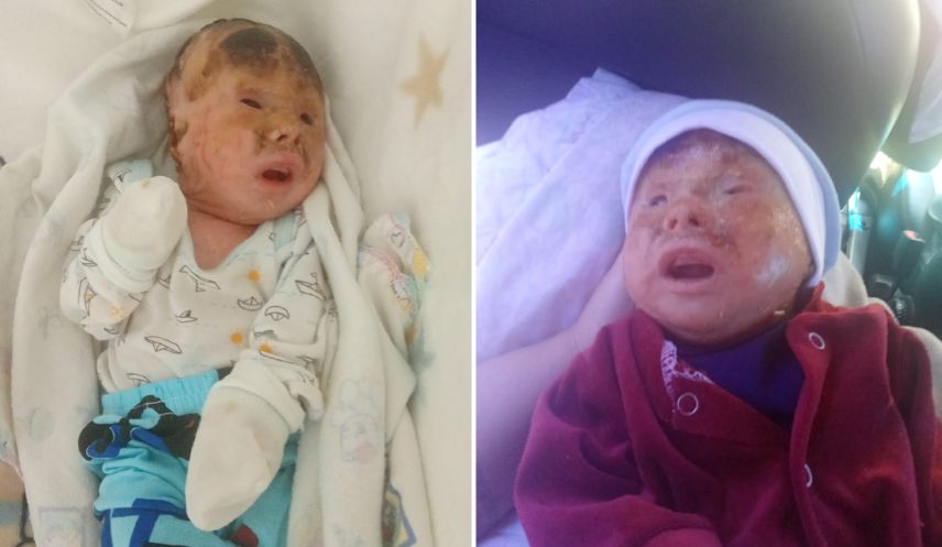 Recém-nascido diagnosticado com doença 'escama de peixe' chora de dor e família implora por tratamento: 