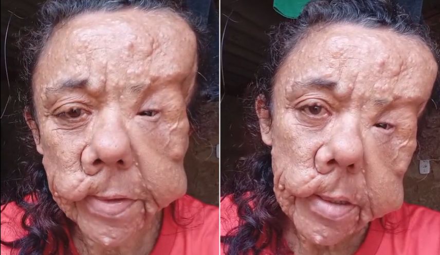 Com tumor no crânio, mulher com doença rara precisa urgentemente de cirurgia: pode perder o movimento da boca, a visão e a audição