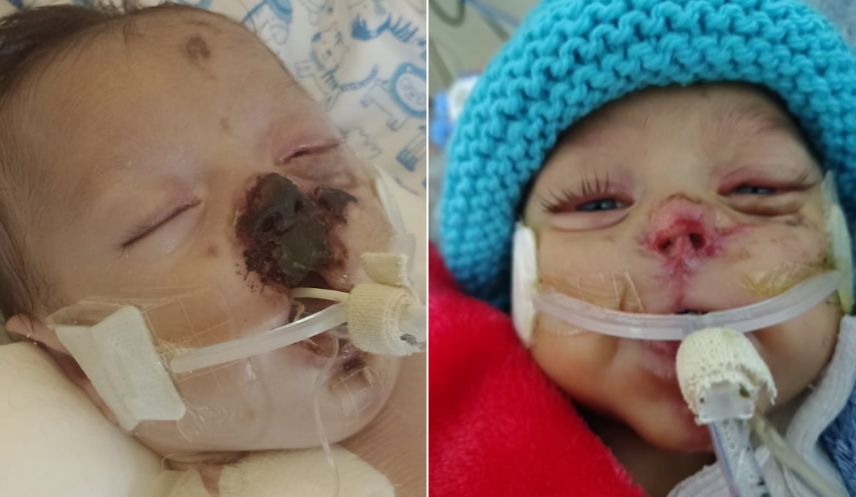 Bebê que nasceu com metade do coração sobrevive a erros médicos e precisa de ajuda com tratamento
