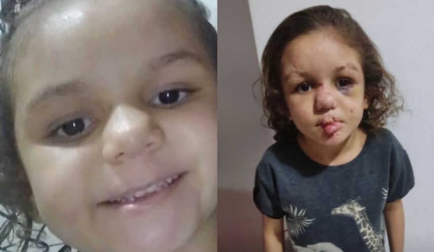 Criança enfrenta deformação no rosto causada por doença rara, e família pede ajuda para tratamento e cirurgia