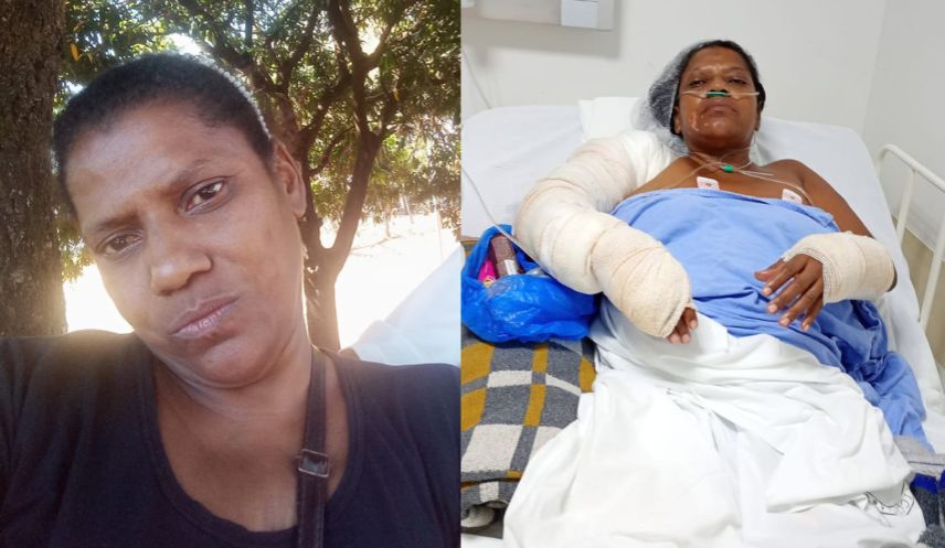 Sem dinheiro pra comprar gás, faxineira sofre graves queimaduras ao usar álcool de posto e ainda pode ser despejada