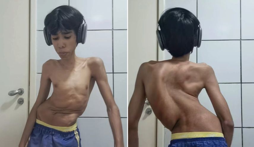 Chamado de “homem torto” na escola, jovem com escoliose grave já pensou em tirar a própria vida e precisa de cirurgia complexa