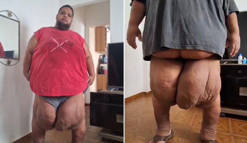 Urgente: homem sofre com linfedema de 40 kg nas pernas, que não para de crescer