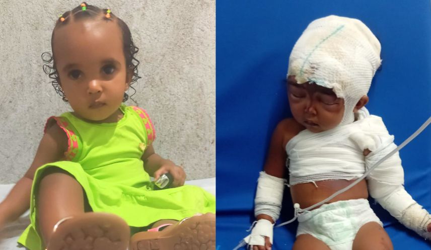 Motoboy pede ajuda para filha de 2 anos que está internada após grave acidente com panela de água fervente