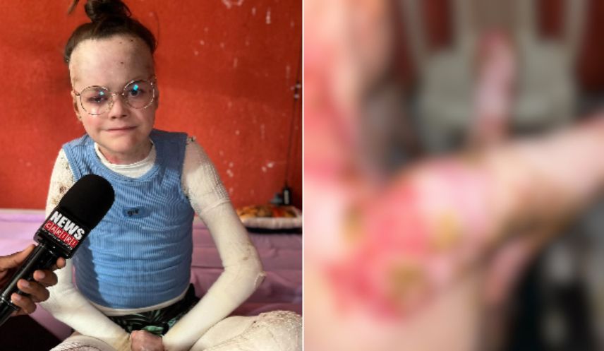 Débora de 18 anos, perdeu todos os dentes e pode ficar sem conseguir comer e ficar cega se não fizer cirurgia urgente!
