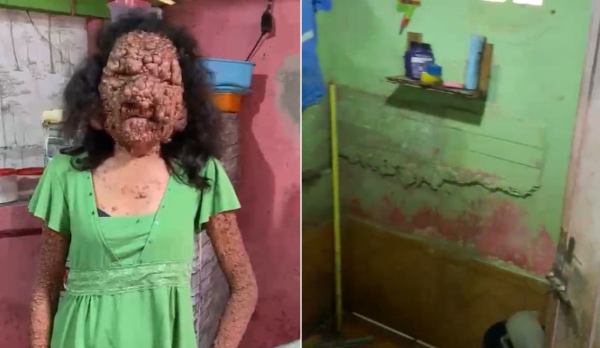 Com o rosto tomado por tumores, Marizete vive em situação de extrema vulnerabilidade e pede ajuda para reformar casa que está caindo