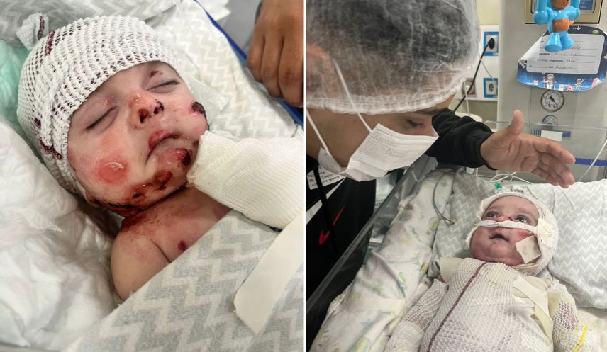 Bebê sofre com doença grave que provoca feridas e dores intensas na pele, e pai perde emprego após faltar para cuidar do filho