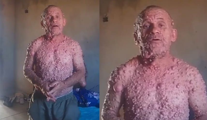 Pai solo de quatro filhos e portador de doença rara, Elson luta contra a dor todos os dias para não faltar a quem mais precisa dele