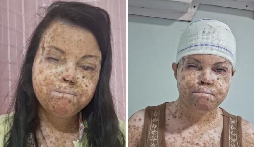 Maria Anne tem xeroderma pigmentoso e fugiu do sol por 27 anos. A chance de operar chegou, mas é em São Paulo, e ela não tem como chegar lá